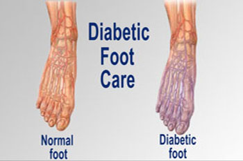 diabetic foot