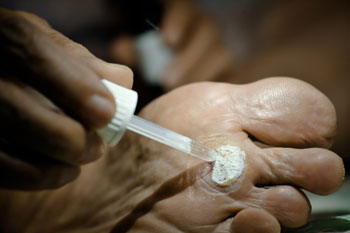 warts
