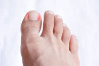 Recognizing Symptoms of Ingrown Toenails