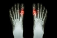 Understanding Painful Gout