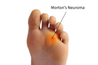 What Is Morton's Neuroma?